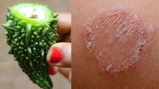 दाद खाज खुजली की 2 दिन में छुट्टी कर देगा Fungal Infection Treatment at Home / Daad Khaj Khujli