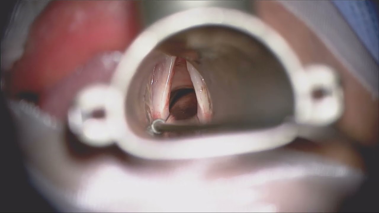 . Excision of Left VC  polyp (micro-flap technique), and lasering of multiple Ectasia (real time)