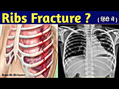 How to read Ribs Fracture on Chest X-ray // How to Count Ribs // Ribs Fracture X-ray // UdayXray