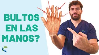 BULKS in the HANDS 🖐😫? What are they and how to treat them 🤩 Fisiolution