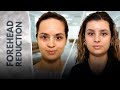 Female Forehead Reduction Before and After | Unedited Result at Heva Clinic #foreheadreduction