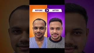 Best Hair Transplant Results in 2026 | Natural Hairline & High Density by Rejuva Aesthetica