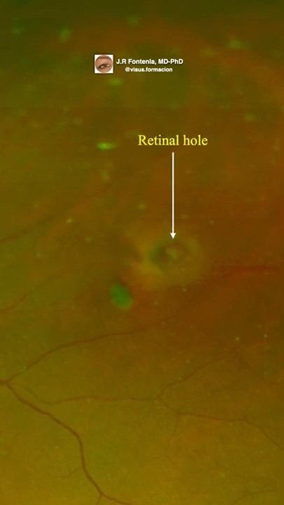 Retinal Tear. Retinal Laser Photocoagulation. #eyes #retinal #eyedisease #doctor #eyedisorder
