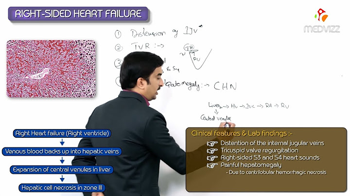 Right sided heart failure elevated central venous pressure