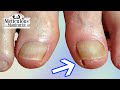 👣How to Remove an Ingrown Big Toenail for Pain Relief Pedicure - Throwback👣