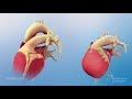 Normal Heart Anatomy vs. Hypoplastic Left Heart Syndrome (HLHS) Anatomy