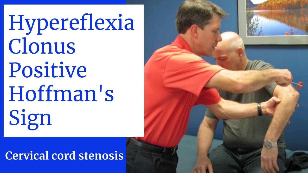 Hyperreflexia, Clonus, Positive Hoffman's Sign- Central Cervical Spine Stenosis