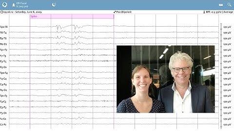 Artificial intelligence for EEG