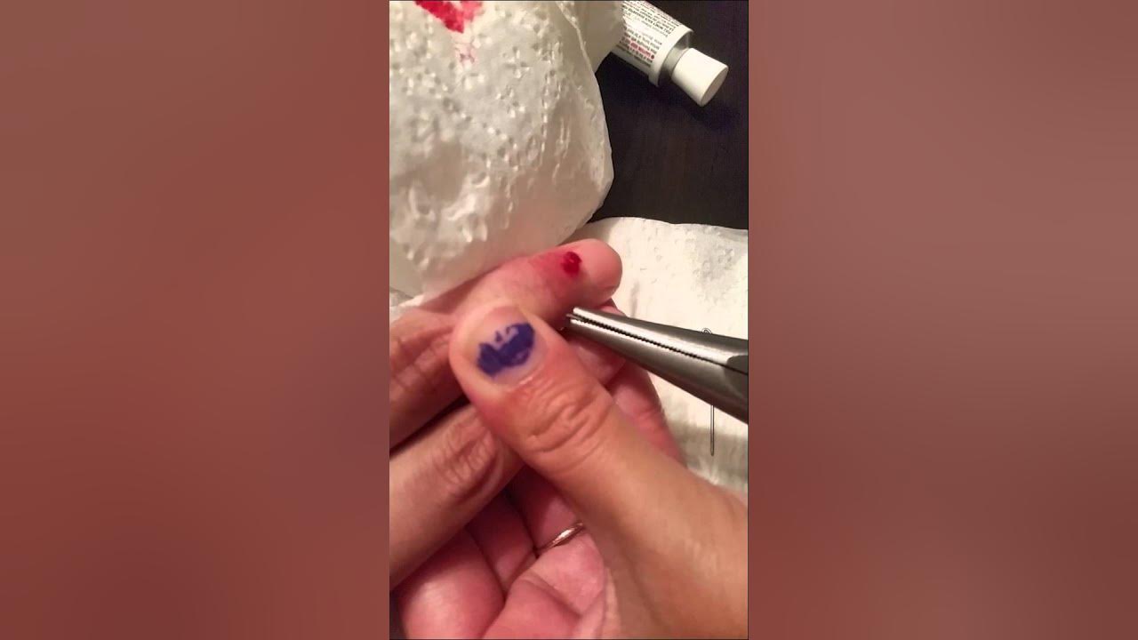 Removing Surgical Pins From Fractured Finger At Home! MUST WATCH! YouTube