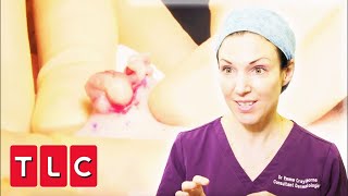 Dr Emma Pops Massive Cyst On Mans Forehead | Bad Skin Clinic screenshot 4