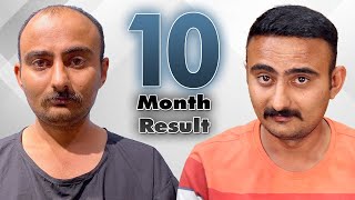 4000+ Grafts | Before After Hair Transplant Results| 29 years | Grade 5 - 6 | Dr. Vivek Galani | RQC