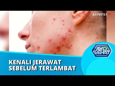 Apa Sih Faktor yang Membuat Jerawat Timbul? Simak Informasi Berikut | AYO SEHAT