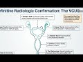 Posterior urethral valve summary