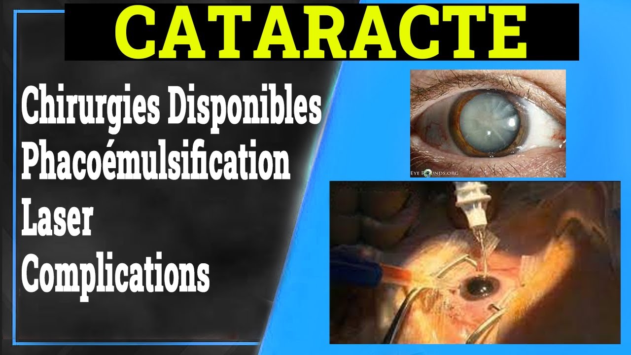 Cataracte Traitement, Chirurgies, Phacoémulsification, Laser — free download