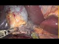 Voiceover of a Robotic Cholecystectomy | ATX Robotic Surgery