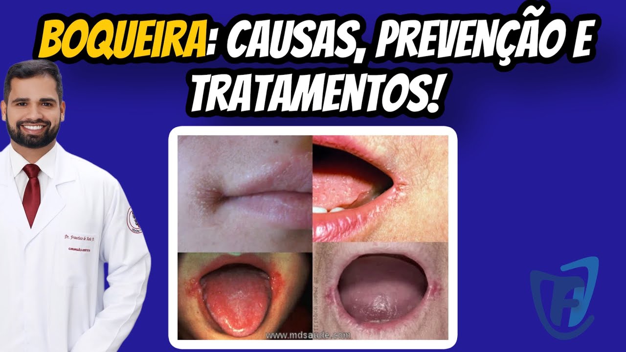 BOQUEIRA, QUELITE ANGULAR: Causas, tratamentos e prevenção! #drfranciscodeassisjr #estomatologia