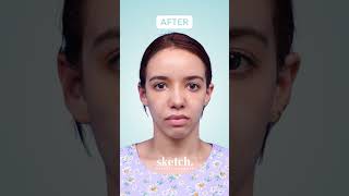 Osteotomy Rhinoplasty Before & After | Sketch Plastic Surgery Osteotomy Rhinoplasty Before & After | Sketch Plastic Surgery