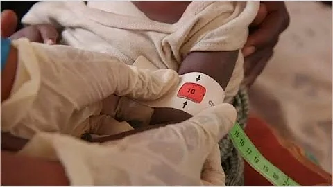 Children displaced by Boko Haram in Nigeria continue to face malnutrition