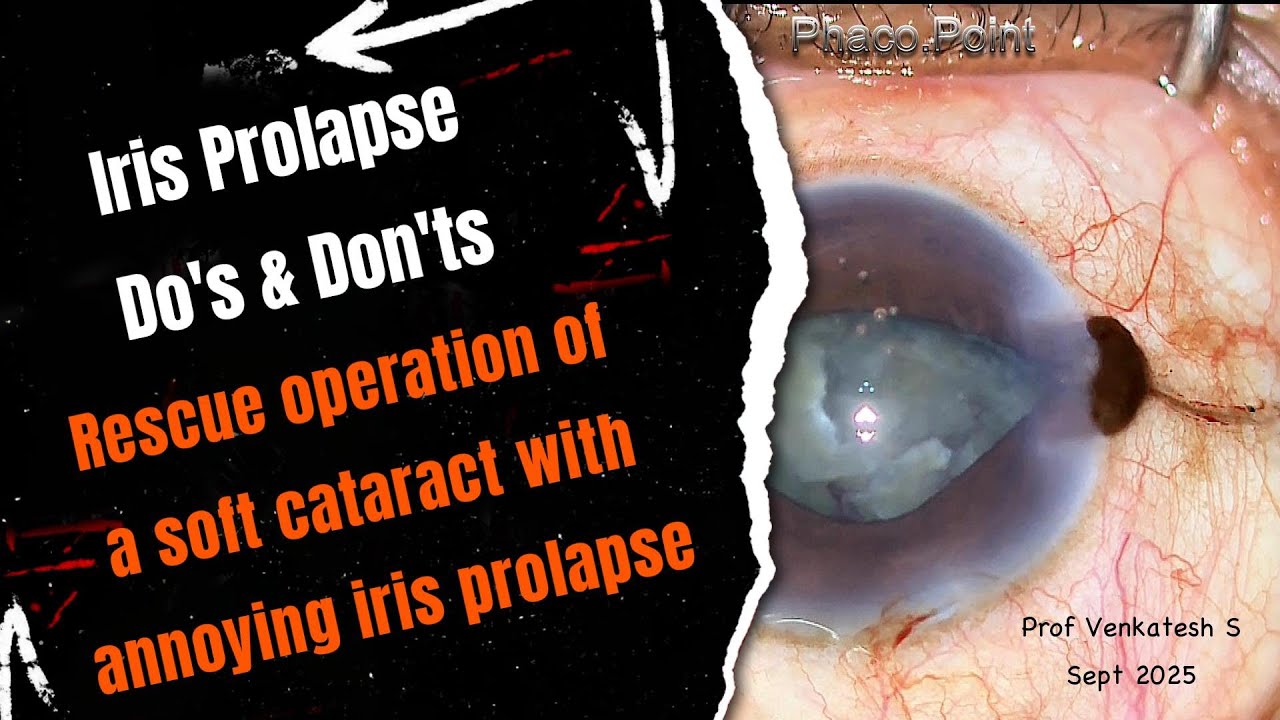 Iris Prolapse Do's and Don'ts - A Rescue operation of a soft cataract ...