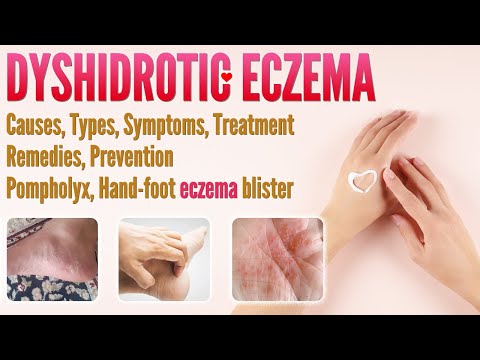 Dyshidrotic Eczema Causes, Types, Symptoms, Treatment, Remedies, and