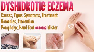 Dyshidrotic Eczema Causes, Types, Symptoms, Treatment, Remedies, and Prevention | Pompholyx eczema