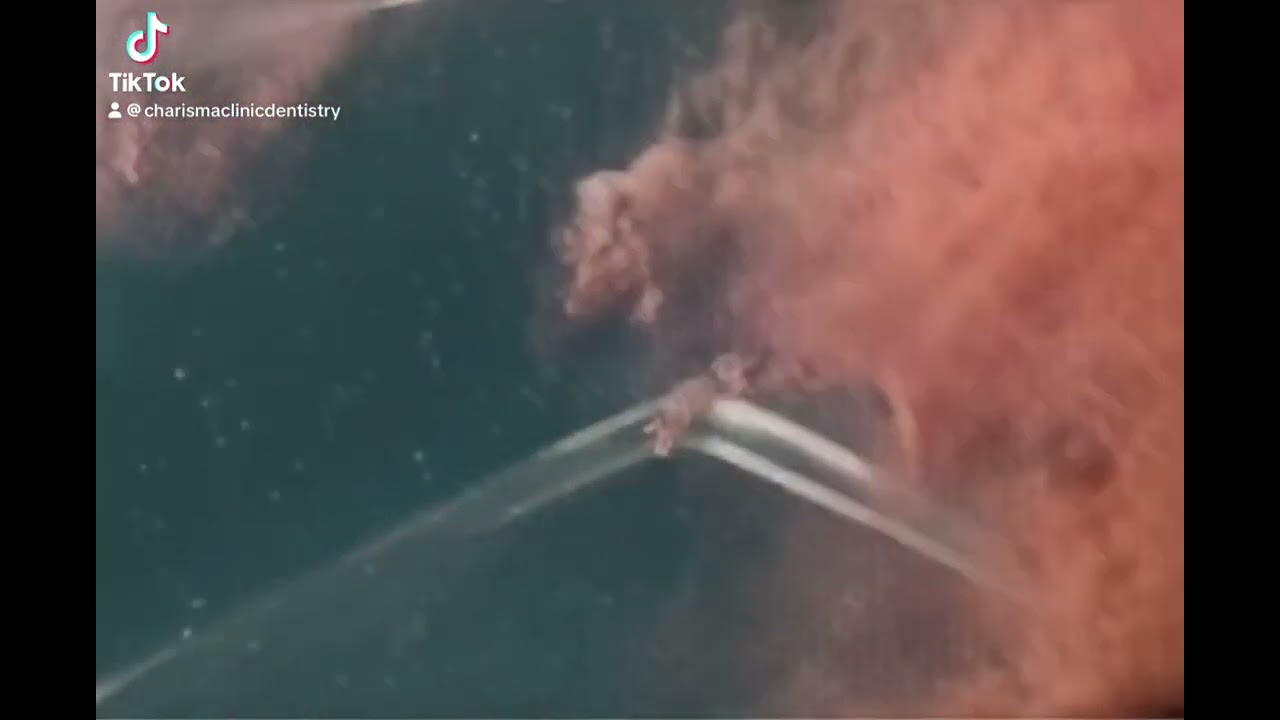 Denture 👋👋👋