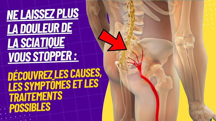 Comprendre la douleur de la sciatique : tout ce que vous devez savoir