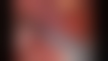 Robotic ileal conduit Step 1: transposition of left ureter