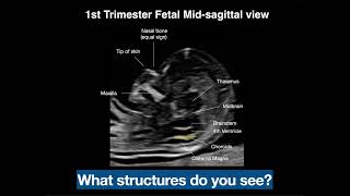The midsagittal view demonstrates essential structures of the fetal brain and profile.