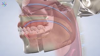 Airway Evaluation in Centennial, Greenwood Village, & Arvada, CO | Village Orthodontics