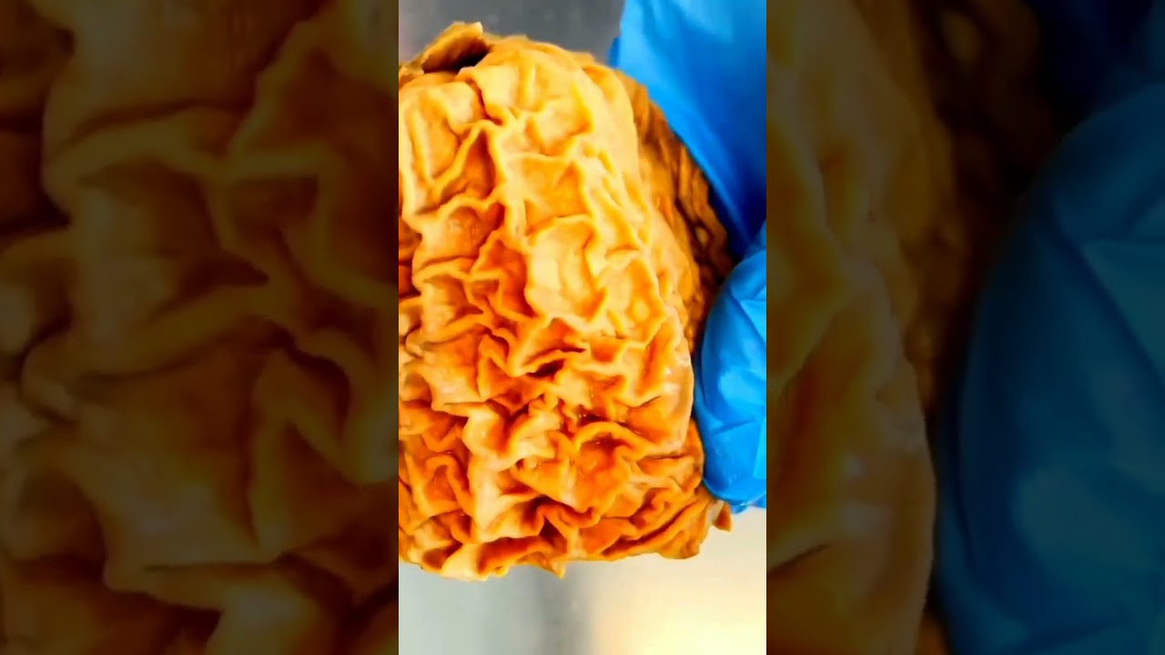 Gastric Rugae In Reall/Know Your Stomach 