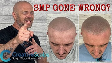 Scalp MicroPigmentation Correction | Creative Scalps