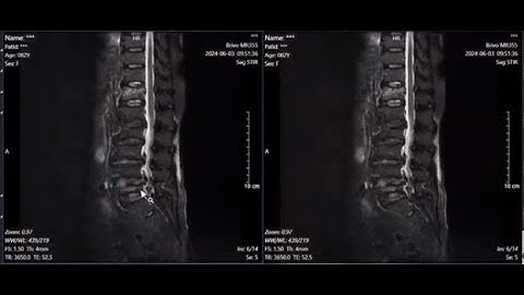 Cập nhật chẩn đoán và điều trị viêm khớp cột sống thể trục