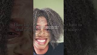 How I Prevent Dandruff and Itchy Scalp🤍 #claymask #antidandruff #hairmask #naturalhair #haircare