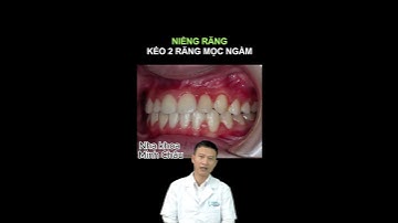 Kéo 2 Răng Mọc Ngầm | Bác Sĩ Yên