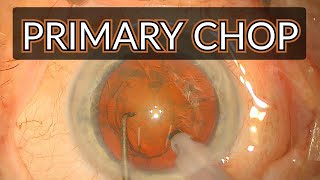 Cataract Surgery | Primary Phaco Chop Technique - No Narration