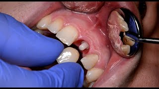 Straumann® PURE Ceramic Implant Monotype: Prosthetic procedure