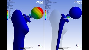 FEA Simulation of Total Hip Replacement Evaluation after Multiple Cycles - ANSYS Static Structural