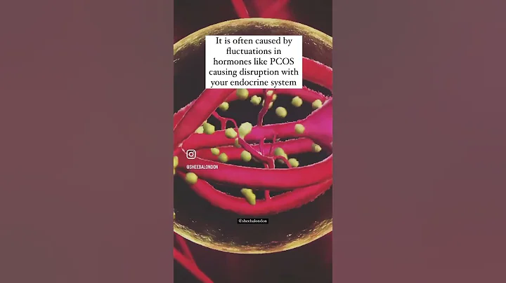 Hormonal acne can be treated with proper skincare #hormonalacne #acnetreatment #acneproneskin #acne