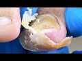 Fungal Infection Causing Yellowing Of The Toes And Shedding Of A Lot Of Dead Skin