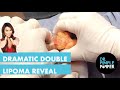 A Dramatic Double Lipoma Reveal