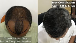 World's Best Hair Transplant in Bangalore Dr Madan