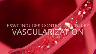 Shockwave Therapy By Kdt