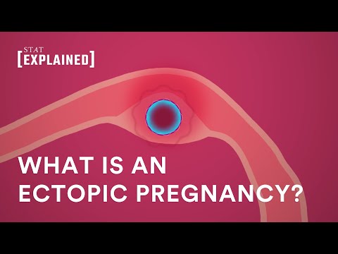 Video: Zijn buitenbaarmoederlijke zwangerschappen levensvatbaar?