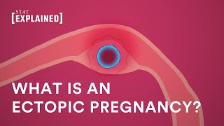 What is an ectopic pregnancy?