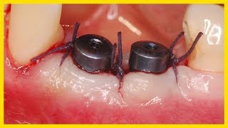 İmplant Diş Yapımı Ve Sonrası - 2017