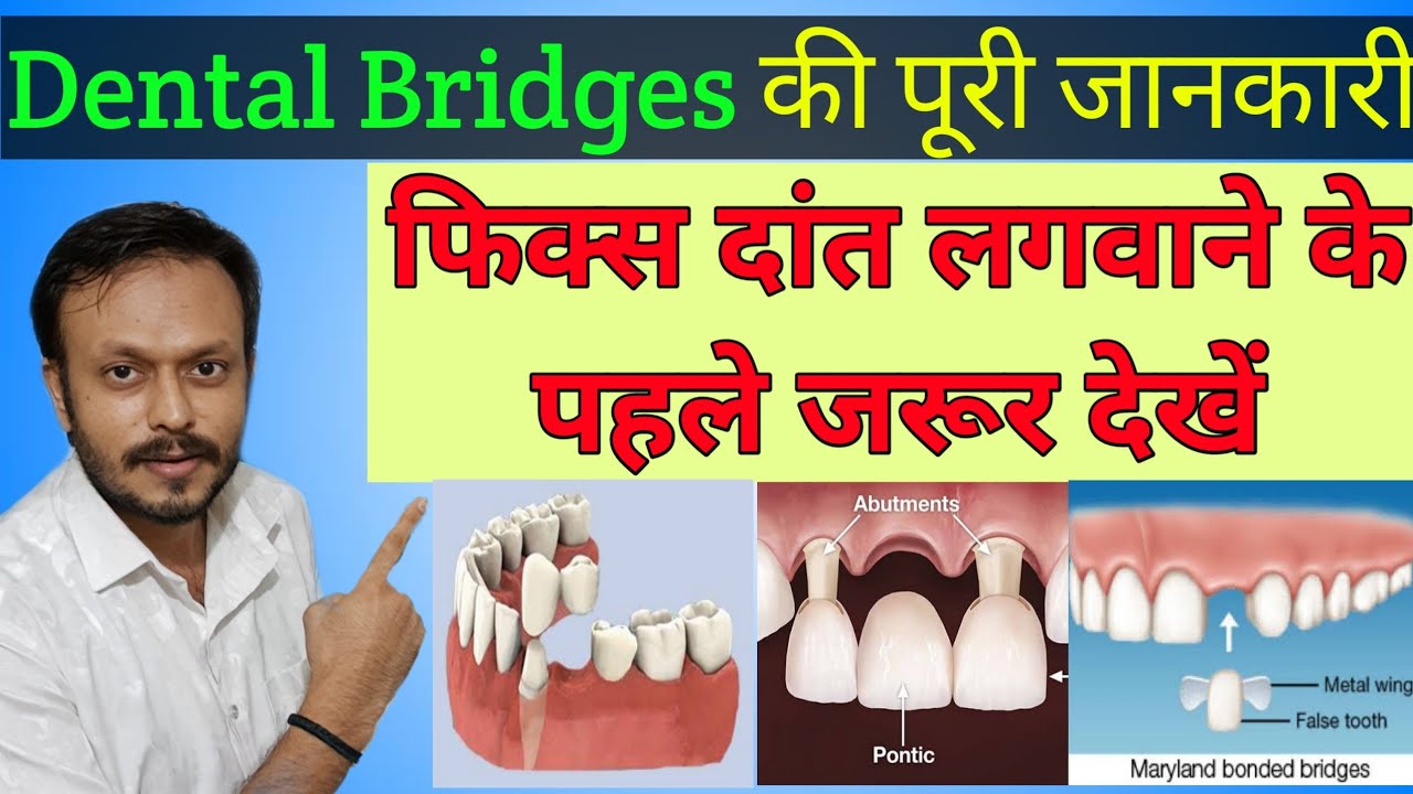 डेंटल ब्रिज के प्रकार ! Types of Dental Bridges in Hindi Tooth