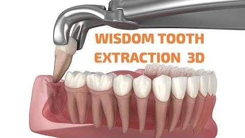 WISDOM TOOTH EXTRACTION | STEP BY STEP | MEDICAL 3D ANIMATION | #eduquest #elearning #learnonline