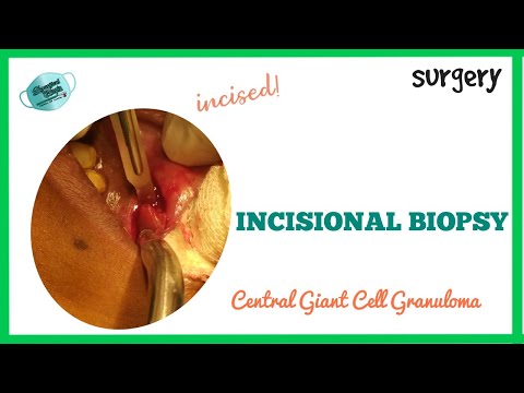 INCISIONAL BIOPSY OF CENTRAL GIANT CELL GRANULOMA || REAL TIME SURGERY