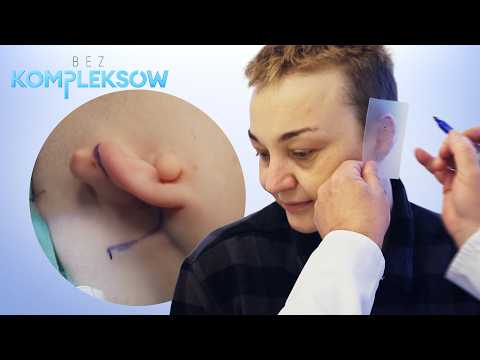 Zrobili jej UCHO Z ŻEBRA? 😮 Chirurg rysował je od zera! | Bez kompleksów